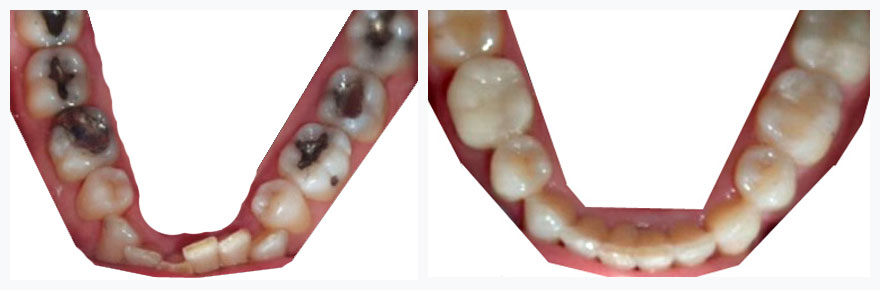 lower teeth before and after invisalign