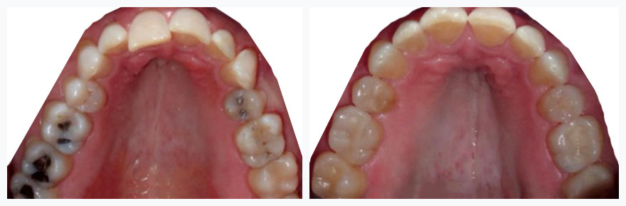 upper teeth before and after invisalign