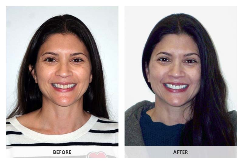 before and after dental veneers and whitening