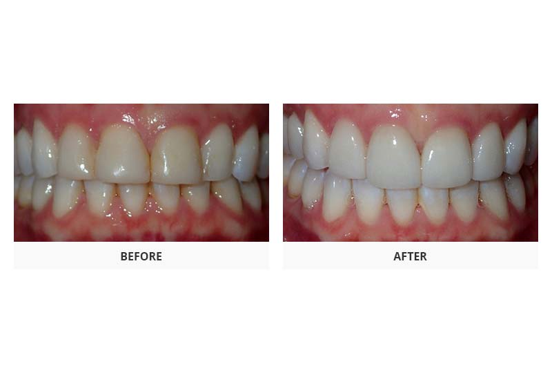 before and after veneers and teeth whitening