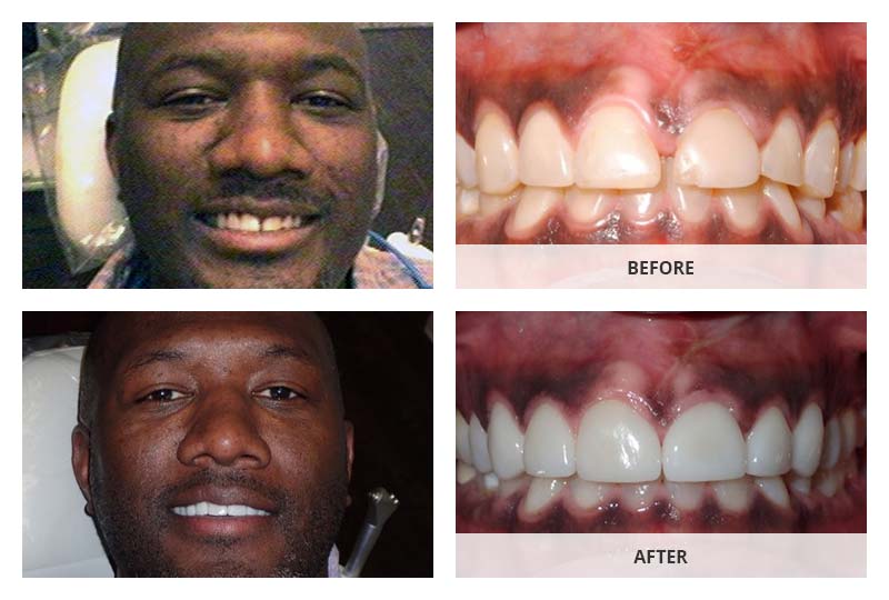 before and after dental veneers