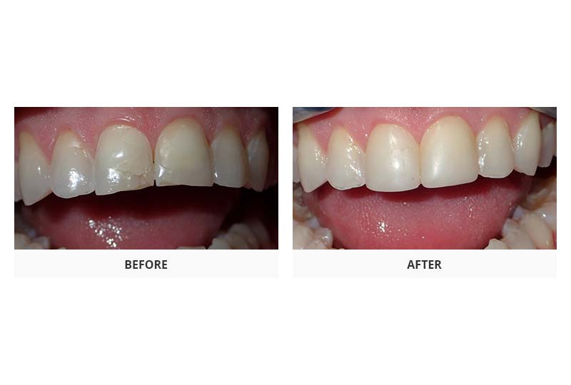 before and after veneers