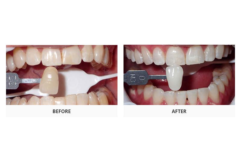 before and after glo teeth whitening