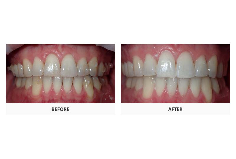 before and after invisalign and dental bonding