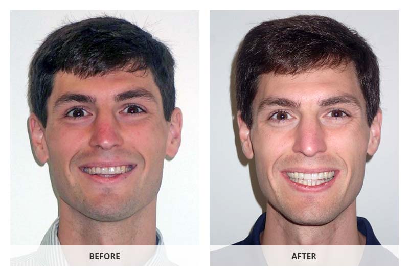 before and after invisalign and whitening