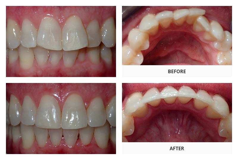 before and after invisalign treatment