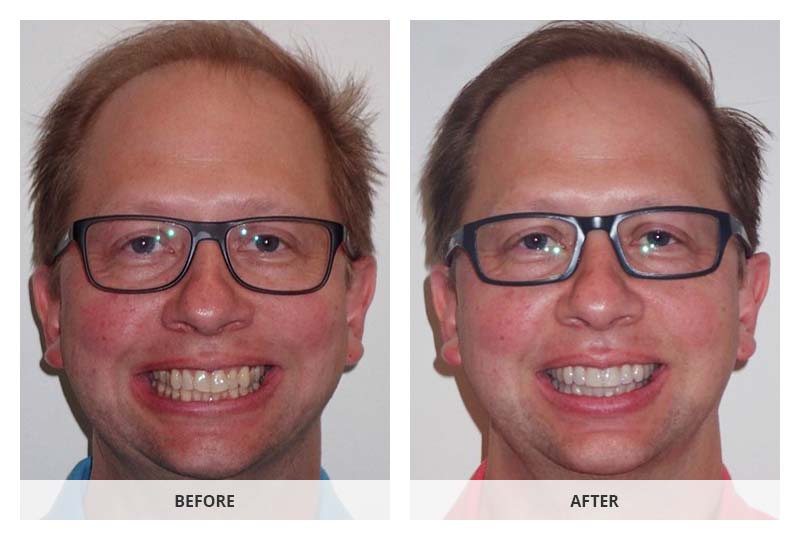 before and after invisalign