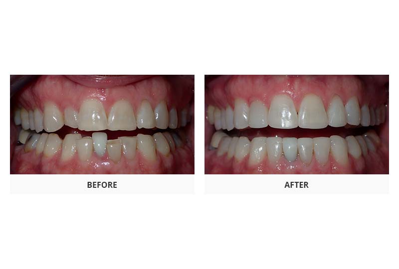before and after invisalign and glo whitening