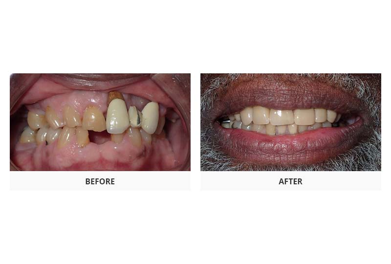 before and after full mouth restoration