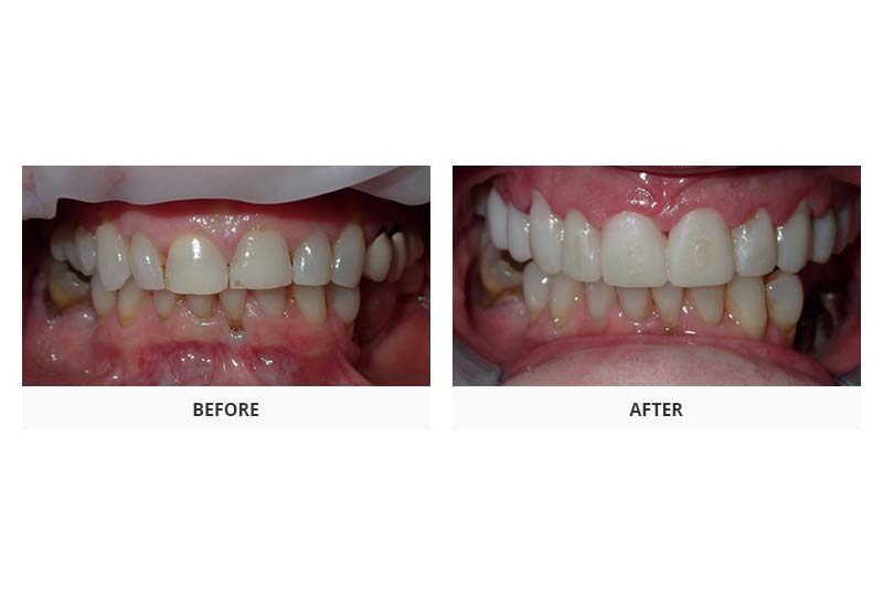 before and after full mouth restoration