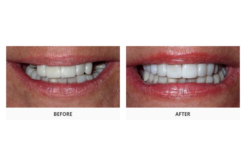 before and after dental implants