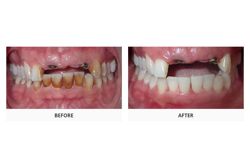 before and after periodontal treatment