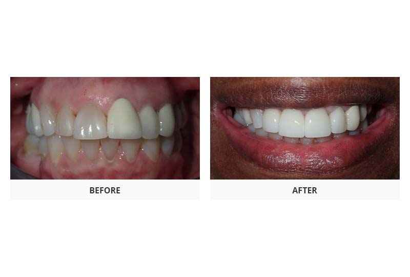 before and after dental crowns and fillings