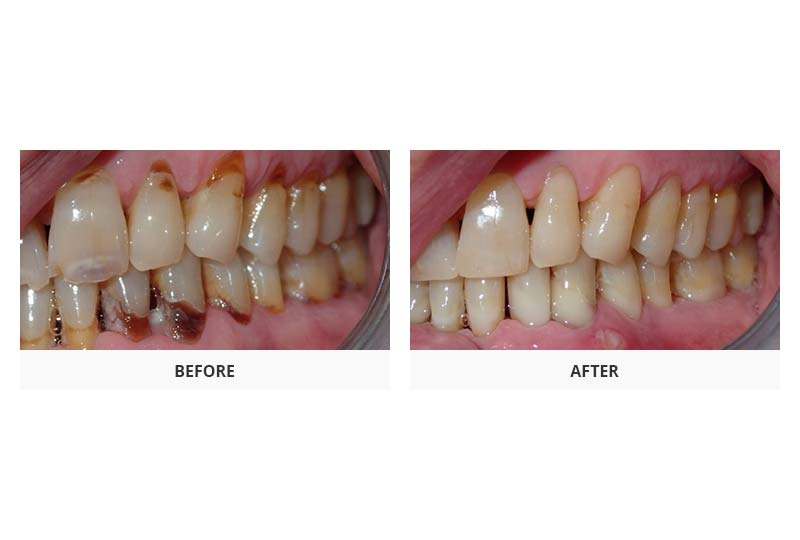 before and after composite fillings